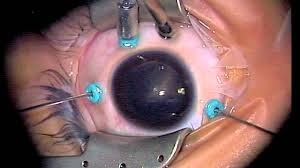 riesgos-de-una-vitrectomia-ocular