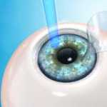 medicina-novedades-en-el-tratamiento-de-las-miodesopsias-en-los-ojos